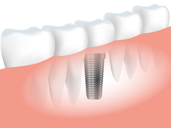 Dental-Implant Andheri West , Mumbai